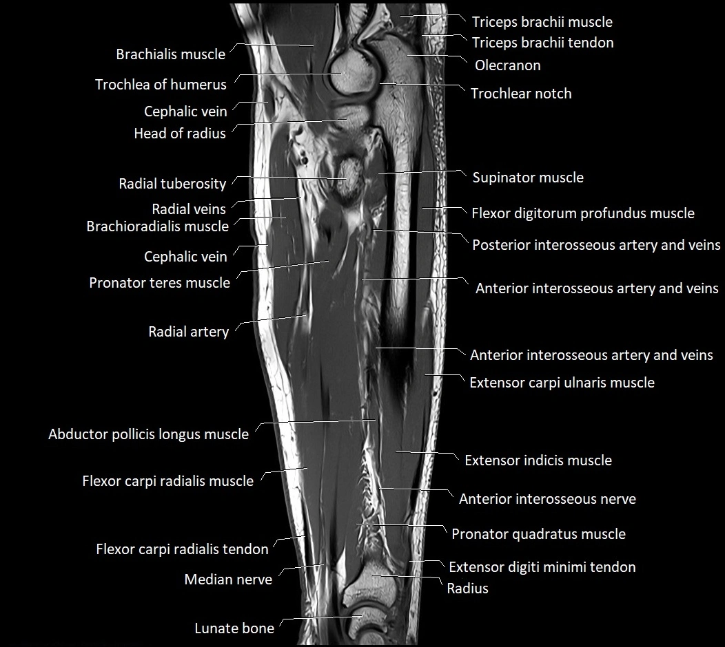 MRI 3T forearm sagittal labelled cross sectional anatomy image 21.webp